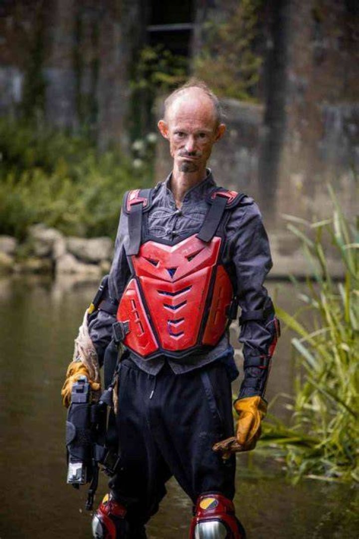 Darren Kent Disability: What was Wrong With Darren Kent Face and Skin?