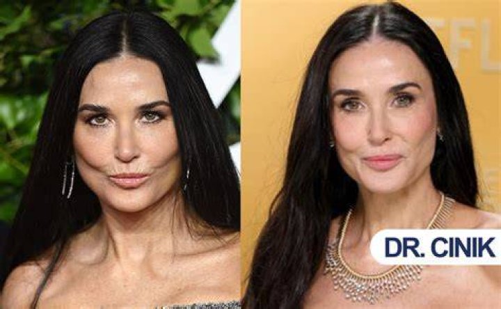 Demi Moore and the Speculation of Plastic Surgery: What You Need to Know