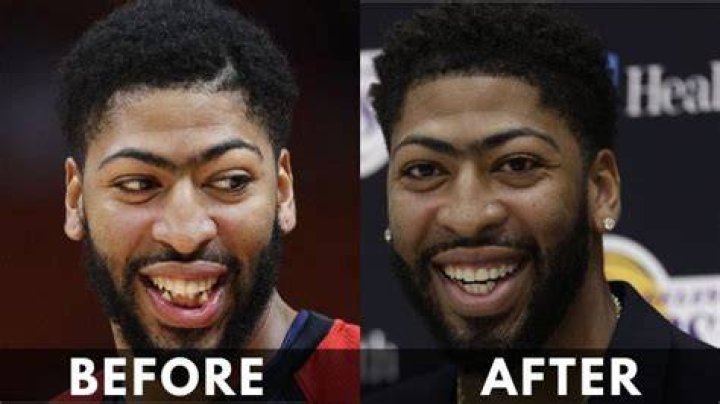 Glimpse Of Anthony Davis Before And After Teeth